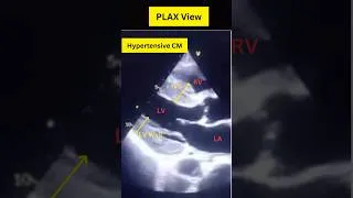 Thumbnail: Effect of Chronic Hypertension on Heart: Concentric Hypertrophy