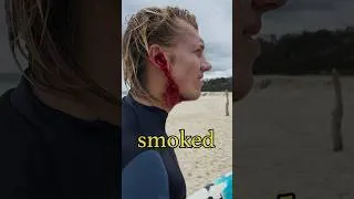 Thumbnail: Getting injured surfing :( #surfing #surf #surfer #australia