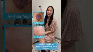 Thumbnail: Helen He, MD, discusses Pulsed Dye Laser
