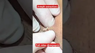 Thumbnail: Armpit extractions. Clearing ingrown hairs #dermatology #education  #skincare