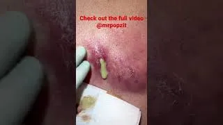 Thumbnail: Large Double Wide Abscess. See full video - https://youtu.be/E6tX-3t1-QE?si=-wX831ckhRxvBd4O