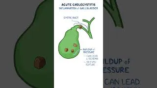 Thumbnail: Acute cholecystitis