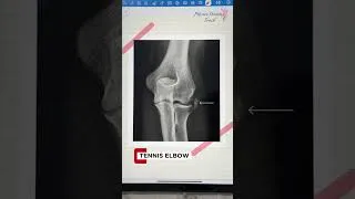 Thumbnail: Calcification Tendinitis?