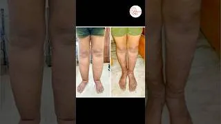 Thumbnail: Lymphedema Swelling Before & After 😱 | Physiotherapy Treatment Results #shortsfeed #lymphedema