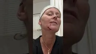 Thumbnail: Neighbors Dog Bit Me In The Face