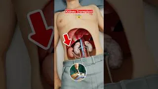 Thumbnail: How Kidney Transplant is Done? (3D) by Professor of How #ad