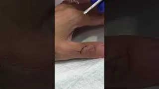 Thumbnail: How to Remove Simple Interrupted Sutures | Left Thumb #shorts #sutureremoval #clinicalskills