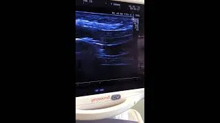 Thumbnail: B Mode Ultrasound of the Diaphragm