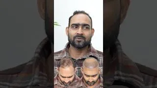 Thumbnail: Amazing Hair Transplant Surgery | Latest Fue Technique #shorts #viral #hair #youtubeshorts