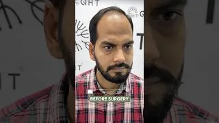 Thumbnail: 11 Months Hair Transplant Result | Latest Fue Technique #shorts #viral #hair #youtubeshorts