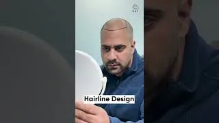 Thumbnail: Amazing Hair Transplant Surgery | Latest Fue Technique #shorts #viral #hair transplant