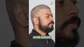 Thumbnail: 13 Months Hair Transplant Result | Latest Fue Technique #shorts #viral #hair #youtubeshorts