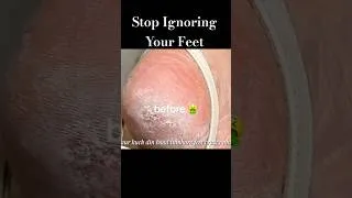 Thumbnail: How to Fix Dry, Rough Feet FAST 😭