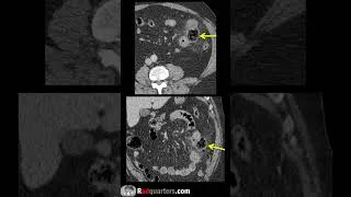 Thumbnail: Small bowel diverticulitis