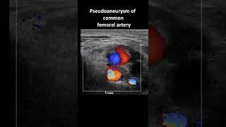 Thumbnail: Pseudoaneurym of the common femoral artery on ultrasound