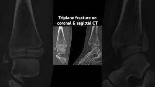 Thumbnail: Triplane ankle fracture on CT