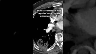 Thumbnail: Pulmonary embolism with “negative vessel” sign of pulmonary infarct