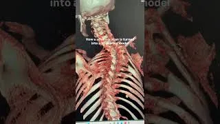 Thumbnail: From the first scan, every step of a child’s #scoliosis journey is carefully planned. 🩻 #shorts