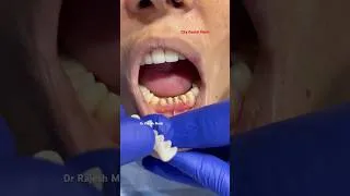 Thumbnail: सामने के टूटे-खराब दांत बने खूबसूरत 😍| 6 Zirconia Crowns Amazing Smile Transformation #dentalshorts