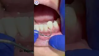 Thumbnail: जर्कोनिया क्राउन की कमाल की फिटिंग | Mandibular Anterior Smile Makeover ✨#trending  #trendingshorts