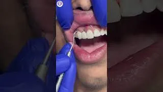 Thumbnail: जर्कोनिया ब्रिज की Perfect Fitting कैसे Check होती है? | 3 Unit Zirconia Bridge#dentalshorts #viral