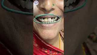 Thumbnail: पूरी तरह सड़े Front Teeth का कमाल बदलाव | 6 Zirconia Crowns Smile Makeover 🦷✨#dentalshorts #zirconia