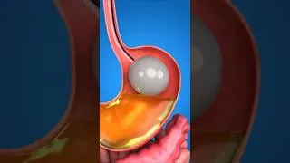 Thumbnail: Gastric Balloon: The Shocking Weight Loss Secret #shorts