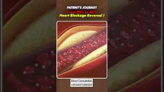 Thumbnail: 90% Heart Blockage Reverse? इस मरीज की कहानी आपको चौंका देगी! | Dr. Bimal Chhajer | SAAOL