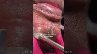 Thumbnail: Lasers for Scars #shorts