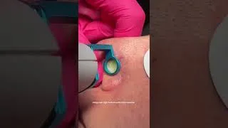 Thumbnail: Red Discoloration Laser Removal #shorts