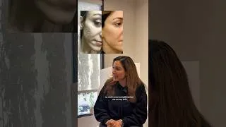 Thumbnail: Acne Scar Laser Treatment #shorts