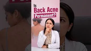 Thumbnail: Why makeup won't fix your back acne scars #skincaretips #acne #skincaregoals