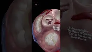 Thumbnail: Heart Valves in Motion 🫀