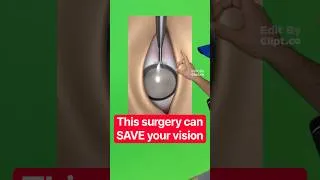 Thumbnail: This surgery can SAVE your vision..