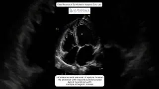 Thumbnail: Recent anterior myocardial infarction. What is wrong?
