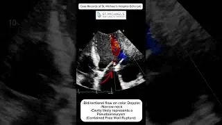 Thumbnail: Recent myocardial infarction with hypotension and heart failure