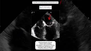 Thumbnail: Recent myocardial infarction, presented with acute pulmonary edema