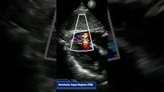 Thumbnail: Someone had a cardiac arrest. What is going on?  #youtubeshorts #echocardiography #heart attack