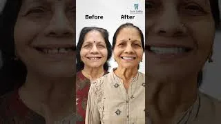 Thumbnail: All-on-4 Dental Implant in Bhopal | Smile Gallery Dental Wellness Centre