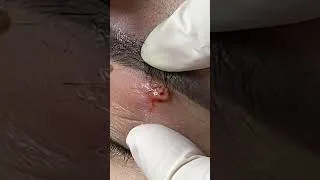 Thumbnail: Shorts Acne treatment #08 #acne #acnetreatment #bigacne #blackheads #mun #gloves #mundauden #nanmun