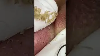 Thumbnail: Shorts acne treatment #07 #acne #acnetreatment #mun #bigacne #acneremove #gloves #nanmun #spalinhmun