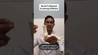 Thumbnail: Sever's Disease: What is it and How is it Treated?