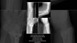 Thumbnail: Essex Lopresti fracture : NEET PG 2023 and NEXT PG :