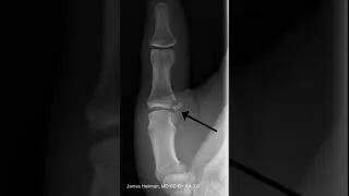 Thumbnail: Game keeper's thumb or Skier's thumb : jammed thumb : NEET PG 2023 and NEXT PG