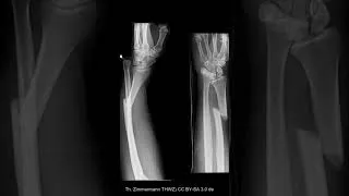Thumbnail: Galeazzi Fracture : Fracture of distal radius : NEET PG 2023 & NEXT PG 2023