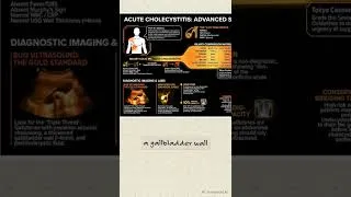 Thumbnail: Acute Cholecystitis- Shorts Video - Longer Link https://youtu.be/0dd1cSOu914?si=PbKtAaL7icMzPeY-