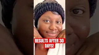 Thumbnail: FINAL RESULTS AFTER USING ANUA Niacinamide 10%+TXA 4% Serum FOR 30 DAYS