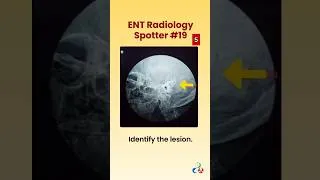 Thumbnail: ENT Radiology Spotter #neetpg #pgentranceexam #theentresident