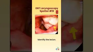 Thumbnail: ENT Laryngoscopy Spotter #neetpg #pgentranceexam #theentresident
