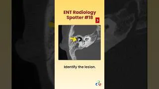 Thumbnail: ENT Radiology Spotter #neetpg #pgentranceexam #theentresident